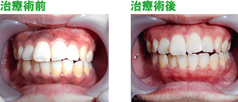 症例の術前と術後